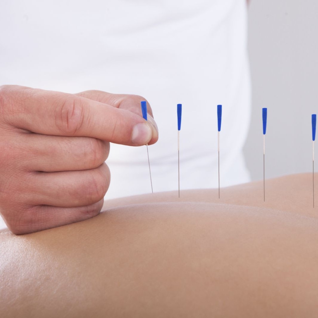 Acupuncture