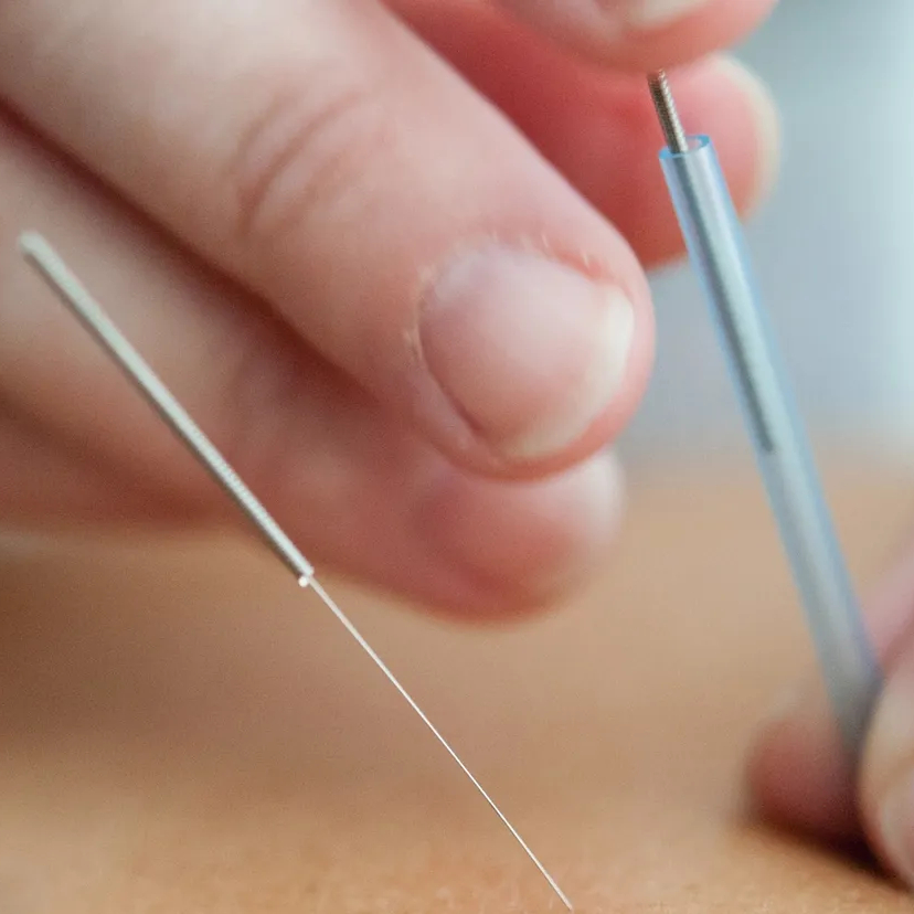 Dry Needling Treatment